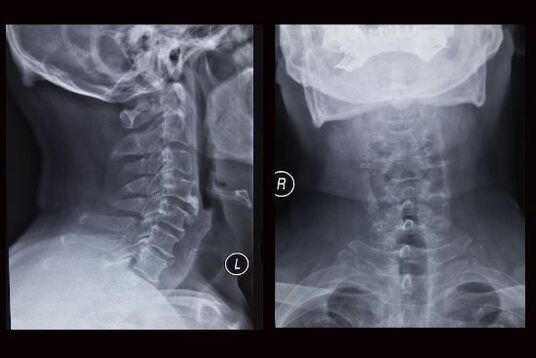 X-ray na imahe ng cervical spine (ang pasyente ay may osteochondrosis)