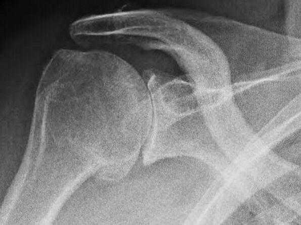 X-ray ng kasukasuan ng balikat na apektado ng arthrosis