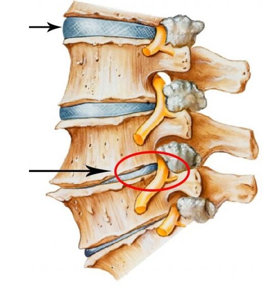 cervical osteochondrosis