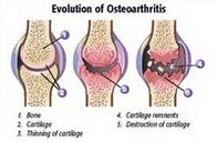 Mga yugto ng arthrosis