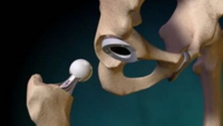 Problema para sa hip joint