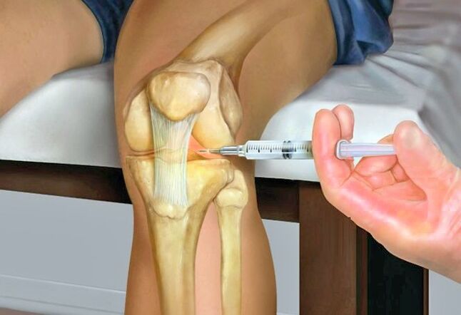 Paggamot ng arthrosis ng kasukasuan ng tuhod