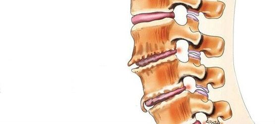 Spondylosis - Pagkasira ng mga intervertebral joints