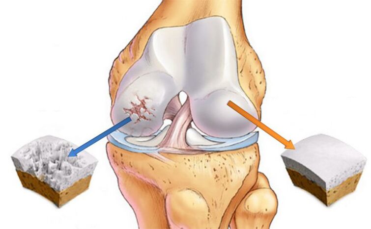 Deforming arthrosis