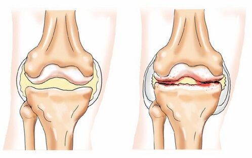 Malusog na pinagsamang at arthrosis