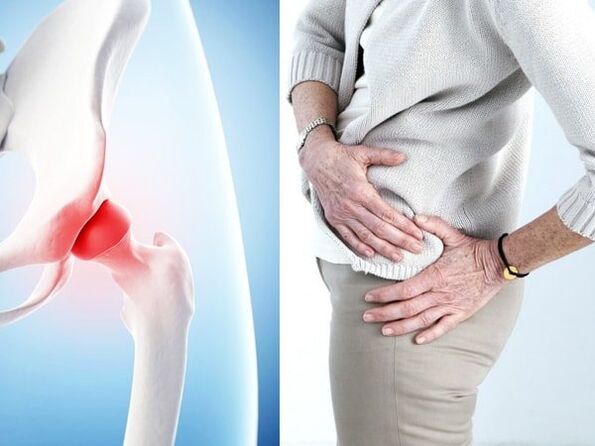 Mga sintomas ng arthrosis ng hip joint