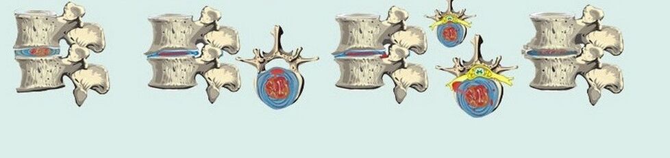 Iba't ibang mga yugto ng thoracic osteochondrosis