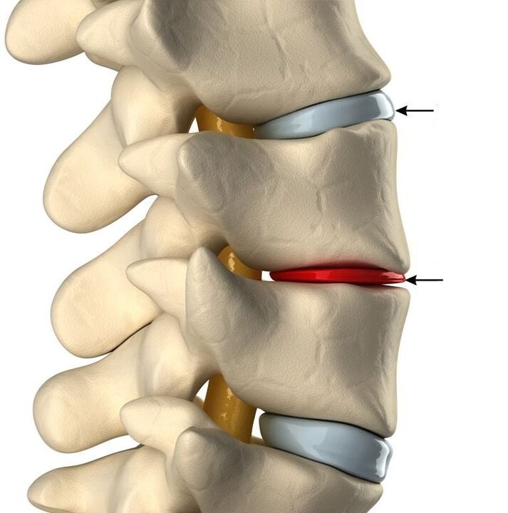 pagkakaiba sa pagitan ng isang malusog na disc at isang disc na may osteochondrosis