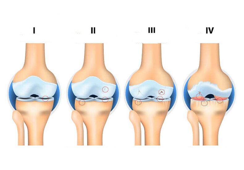 Mga yugto ng magkasanib na arthrosis