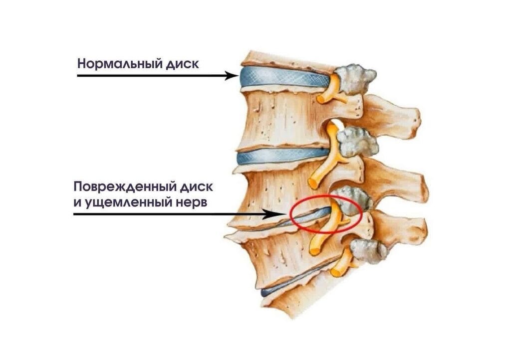Mga sintomas ng cervical osteochondrosis