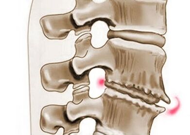 pinsala sa vertebrae sa thoracic osteochondrosis