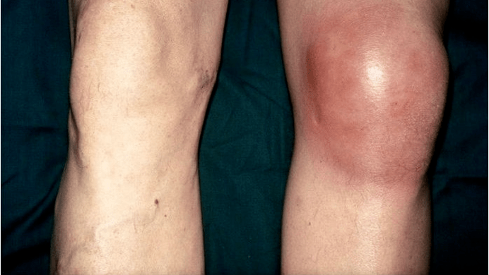 arthrosis at arthritis