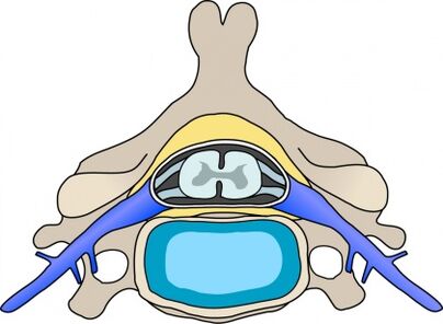 protrusion sa vertebra na may servikal osteochondrosis