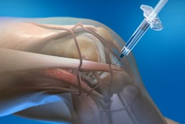 intra-articular injection para sa arthrosis ng kasukasuan ng tuhod